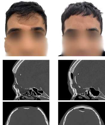 Patient before and after reconstruction, with CT scans of the frontal cranial defect