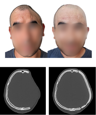 Patient before and after reconstruction, with axial CT scans