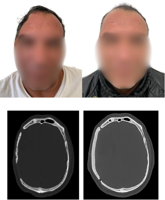Patient before and after reconstruction, with axial CT scans