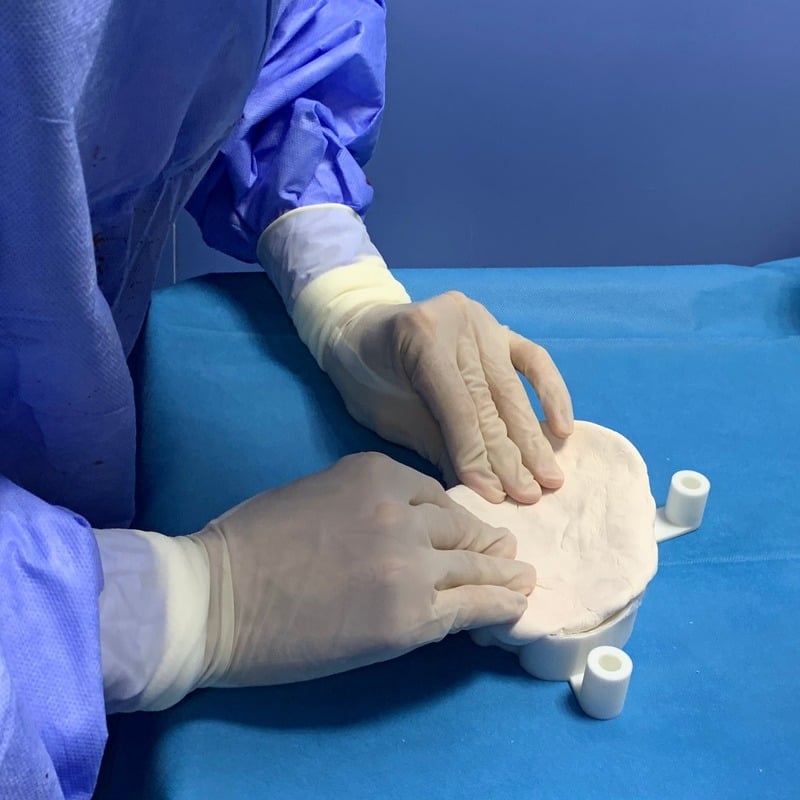 PMMA molding on the patient-specific mold