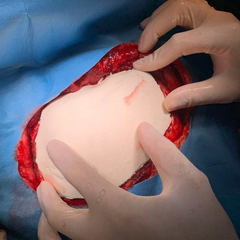 Placement of the implant intraoperatively
